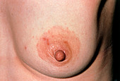 Eczema around the nipple of a woman's breast