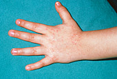 Close up of child's hand with cat allergy eczema