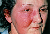 View of reddening due to erysipelas on womans face