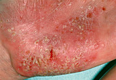 Close-up of eczema on the palm of a hand