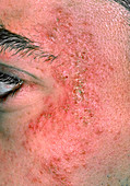 Eczema on the side of a man's face
