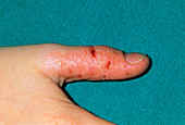 Eczema on child's thumb due to thumb-sucking