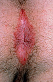 Eczema around anus,with pruritis ani (itching)