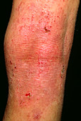 Acute eczema seen on the leg of 12 year-old boy