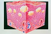 Artwork of eczema in section of skin epidermis