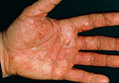 Close-up of patient's hands with discoid eczema