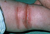 Close-up of atopic eczema in bend of child's leg