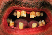Irregular dentition caused by ectodermal dysplasia