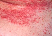 Seborrheic eczema