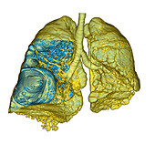 Emphysema of the lungs,CT scan