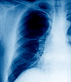 Emphysema,X-ray