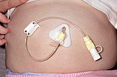 Gastrostomy tube in a baby