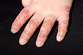 Infected eczema