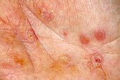 Eczema