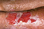Infected varicose eczema