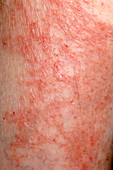 Eczema