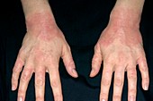 Eczema affecting the wrists