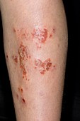 Infected eczema