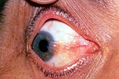 Pterygium eye disease