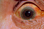 Glaucoma: close-up of inflamed eye