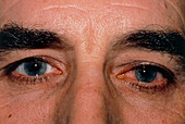 Man with acute iritis