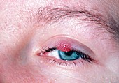 Chalazion (meibomian cyst) on upper eyelid