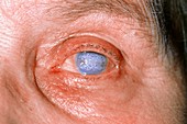 Severe corneal scarring in an elderly lady