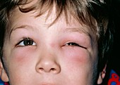 Child affected by periorbital oedema