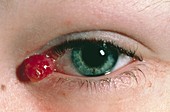 Pyogenic granuoma of eye in young patient