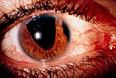 Glaucoma: swollen irregular pupil: no contact lens