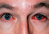 Inflamed eyes caused by viral conjunctivitis