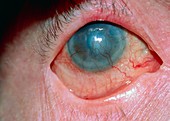 Keratopathy (corneal damage) & neovascularisation