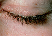 Blepharitis or inflammation of the eyelid