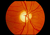 Ophthalmoscope view of retina with optic atrophy