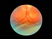 Ophthalmoscope view of a detached retina