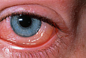 Eye: allergic conjunctivitis & conjunctival oedema