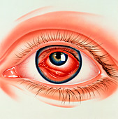 Abstract illustration of eye with conjunctivitis