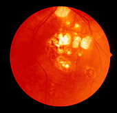 Ophthalmoscope view of retina in toxoplasmosis