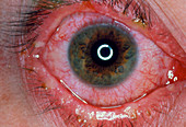 Eye with conjunctivitis