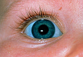Close-up of baby's eye with blue sclera