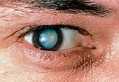 Male patient's eye with mature cataract