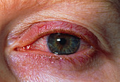 Close up of iritis seen in eye of 30 year old man