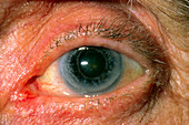 Close-up of patient's eye with early cataract