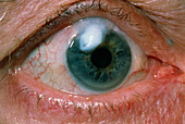Eye bleb on elderly patient after eye surgery