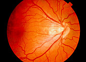 Ophthalmoscope view:retinopathy due to prematurity