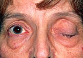 Close-up of drooping eyelid (ptosis) in a woman