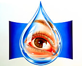 Artwork of an eye with conjunctivitis in tear drop