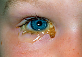 Acute conjunctivitis & discharge from child's eye