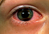 Hyphaema of the eye caused by a trauma