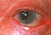 Distorted eye pupil